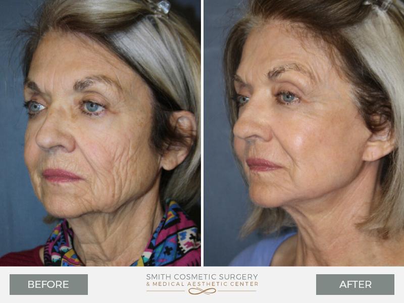 Smith Cosmetic Surgery facelift result — Centennial, CO