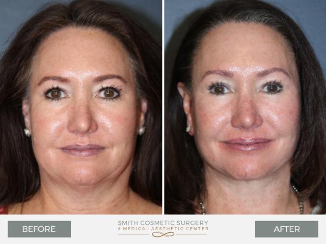 Mini Facelift result at Smith Cosmetic Surgery in Centennial, CO