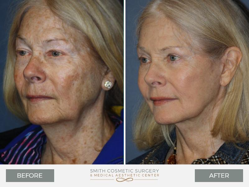 Smith Cosmetic Surgery facelift result — Centennial, CO