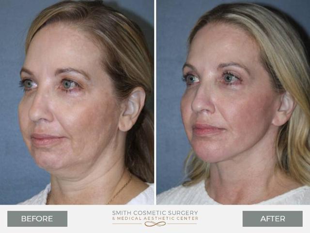 Neck Lift result at Smith Cosmetic Surgery in Centennial, CO