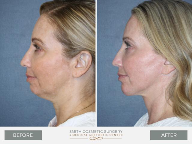 Chin Implant result at Smith Cosmetic Surgery in Centennial, CO