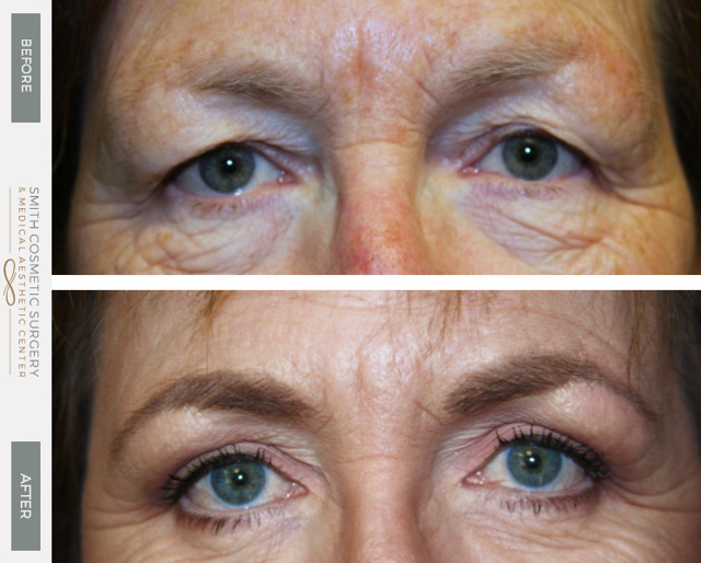 Brow Lift result at Smith Cosmetic Surgery in Centennial, CO