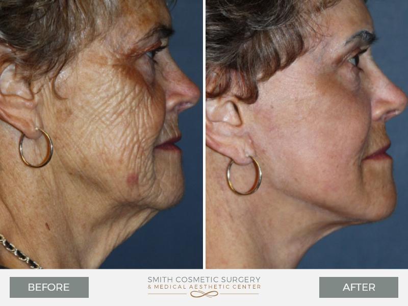 Smith Cosmetic Surgery facelift result — Centennial, CO