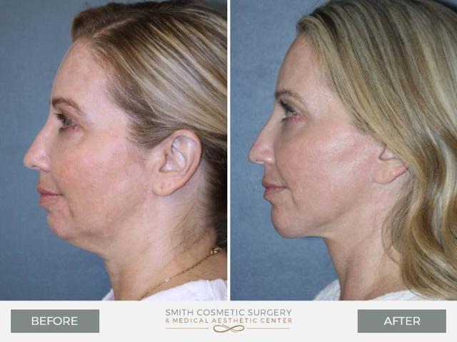 Neck Lift result at Smith Cosmetic Surgery in Centennial, CO