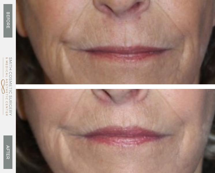 Smith Cosmetic Surgery facelift result — Centennial, CO