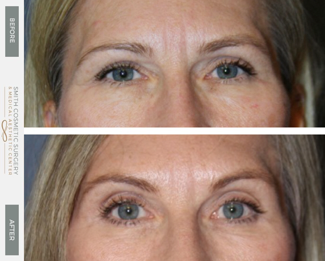 Brow Lift result at Smith Cosmetic Surgery in Centennial, CO