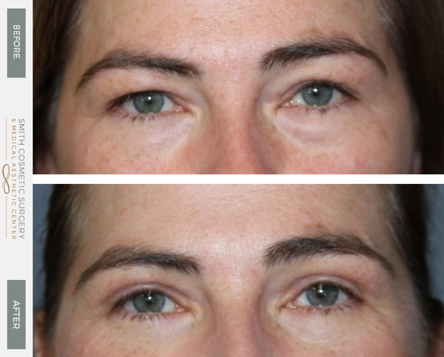 Blepharoplasty result at Smith Cosmetic Surgery in Centennial, CO