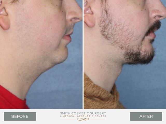 Chin Implant result at Smith Cosmetic Surgery in Centennial, CO