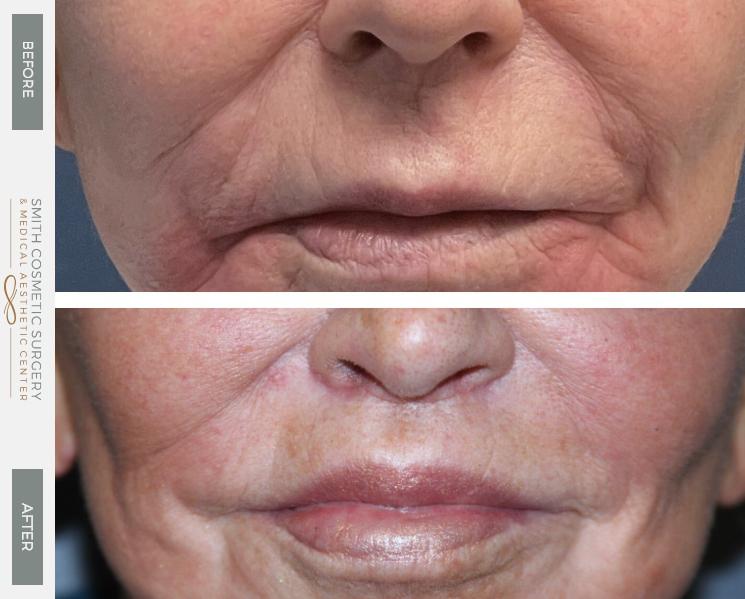 Smith Cosmetic Surgery facelift result — Centennial, CO