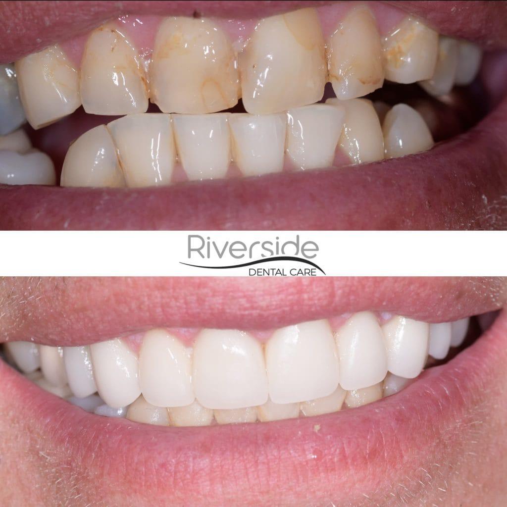 Riverside Dental Care veneers result — St. George, UT