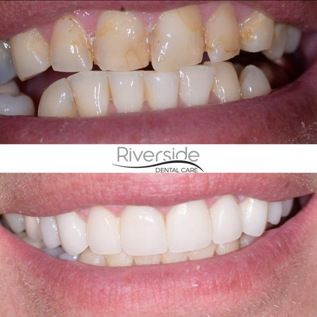 Dental Implants result at Riverside Dental Care in St. George, UT