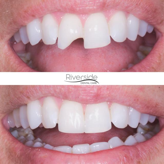 Dental Veneers result at Riverside Dental Care in St. George, UT