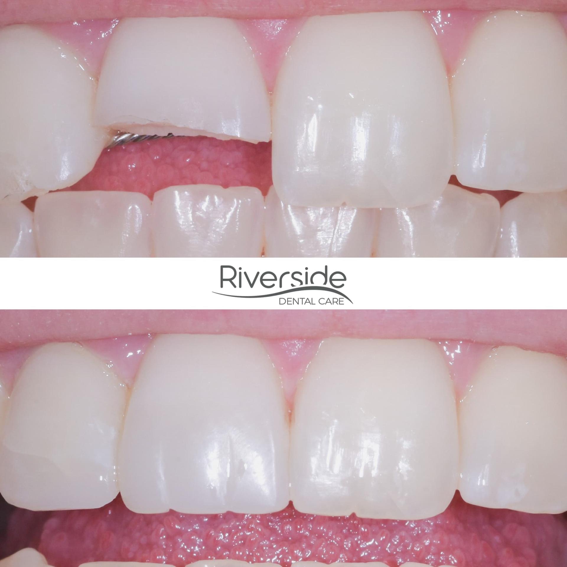 Riverside Dental Care veneers result — St. George, UT