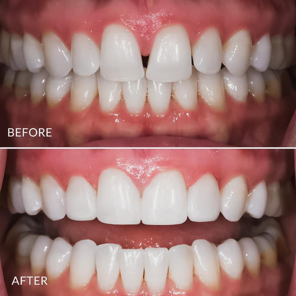 Riverside Dental Care veneers result — St. George, UT