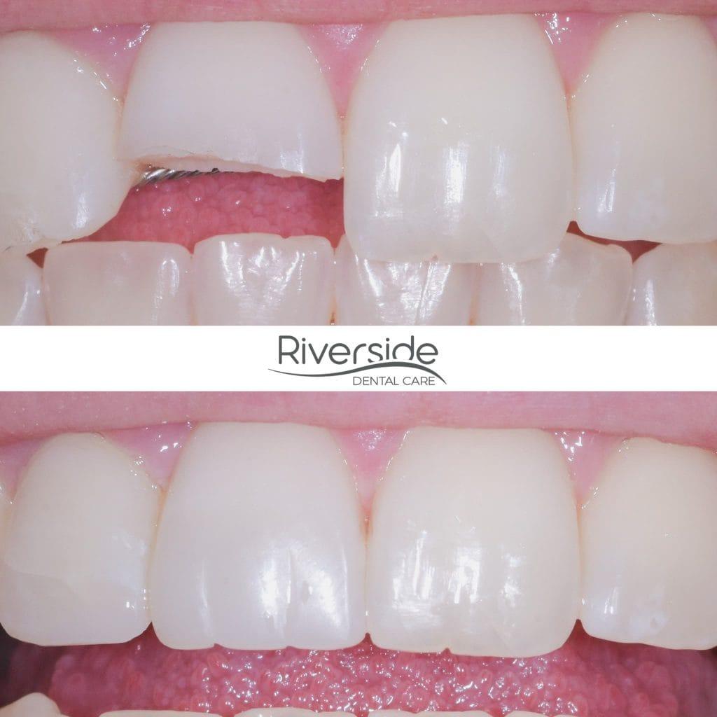Riverside Dental Care veneers result — St. George, UT