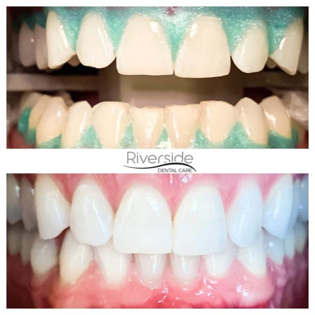 Dental Veneers result at Riverside Dental Care in St. George, UT