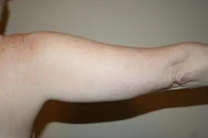 Tim Neavin, MD arm lift after — Beverly Hills, CA
