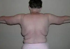 Tim Neavin, MD arm lift after — Beverly Hills, CA