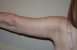 Tim Neavin, MD arm lift after — Beverly Hills, CA