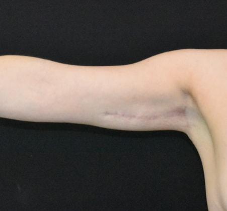 Arm Lift after at SynergyMD Plastic Surgery in Tampa, FL