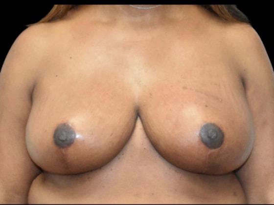 SynergyMD Plastic Surgery breast reduction after — Tampa, FL