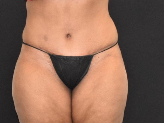 SynergyMD Plastic Surgery tummy tuck after — Tampa, FL