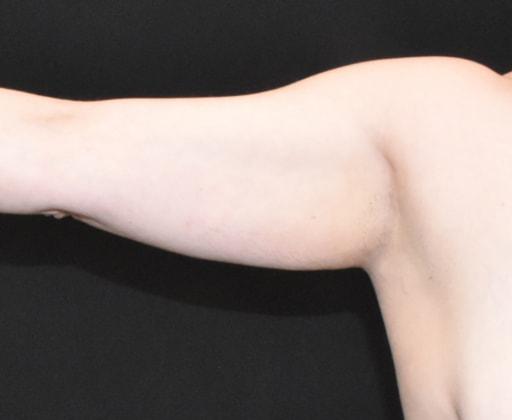 Arm Lift before at SynergyMD Plastic Surgery in Tampa, FL