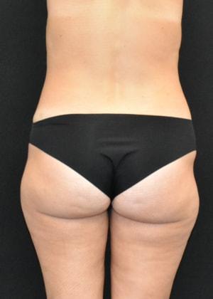Liposuction before at SynergyMD Plastic Surgery in Tampa, FL