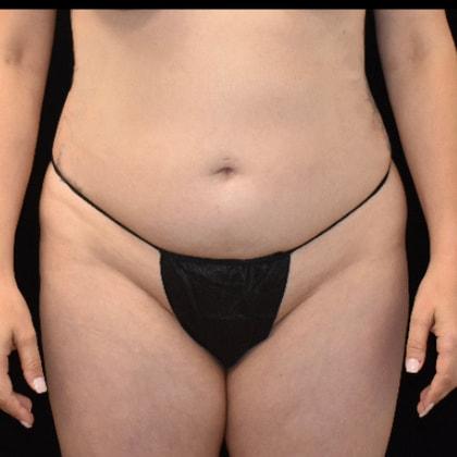 Liposuction before at SynergyMD Plastic Surgery in Tampa, FL