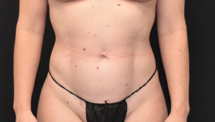 SynergyMD Plastic Surgery liposuction after — Tampa, FL