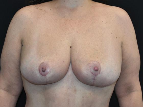 SynergyMD Plastic Surgery breast reduction after — Tampa, FL