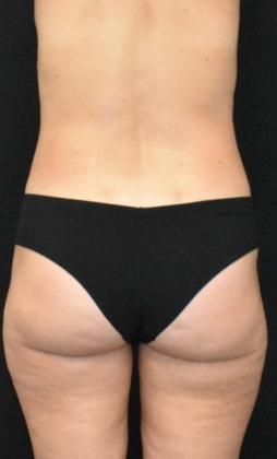 Liposuction after at SynergyMD Plastic Surgery in Tampa, FL