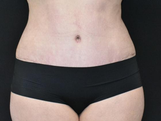 SynergyMD Plastic Surgery tummy tuck after — Tampa, FL