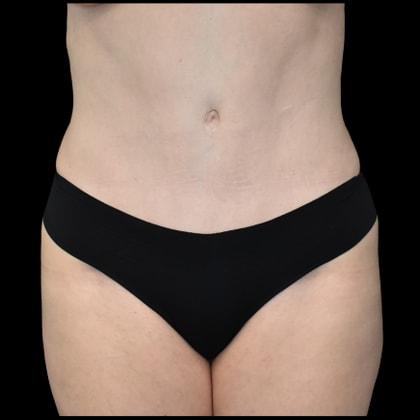 SynergyMD Plastic Surgery tummy tuck after — Tampa, FL