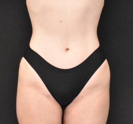 SynergyMD Plastic Surgery liposuction after — Tampa, FL