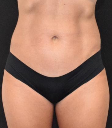SynergyMD Plastic Surgery tummy tuck after — Tampa, FL