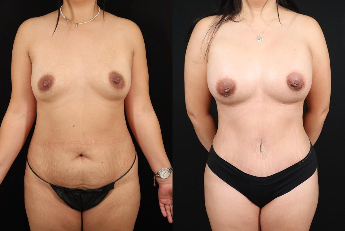 Boston Center for Plastic Surgery (BCPS) mommy makeover result — Newton, MA