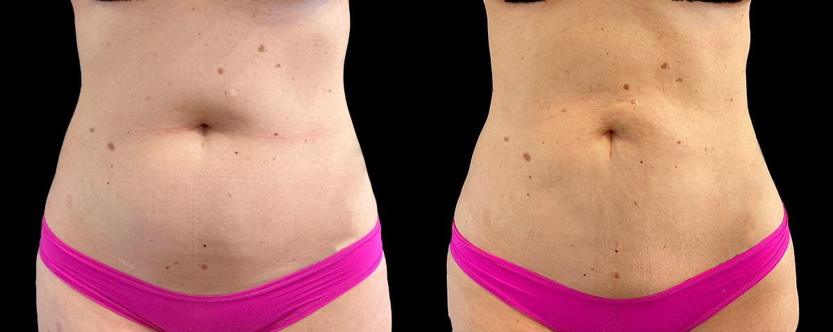 Boston Center for Plastic Surgery (BCPS) liposuction result — Newton, MA