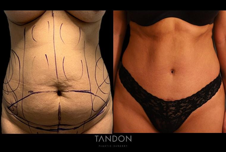 Boston Center for Plastic Surgery (BCPS) tummy tuck result — Newton, MA