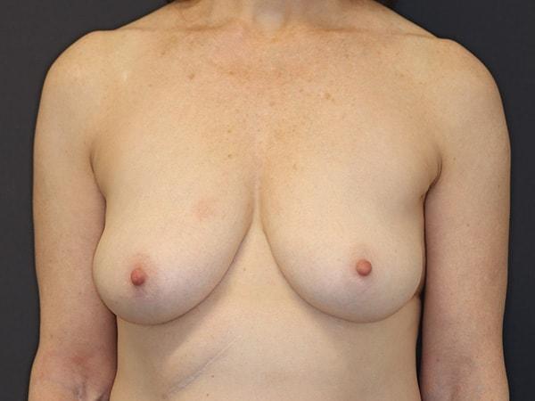 Breast Lift before at James P. Anthony, MD in San Francisco, CA