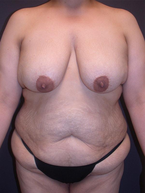 Mommy Makeover before at James P. Anthony, MD in San Francisco, CA