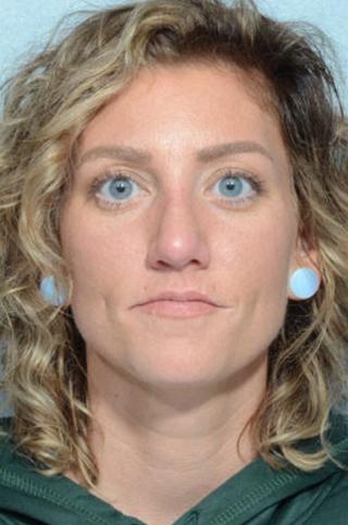 Rhinoplasty after at Chegar Facial Plastic Surgery in Carmel, IN