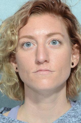 Rhinoplasty before at Chegar Facial Plastic Surgery in Carmel, IN