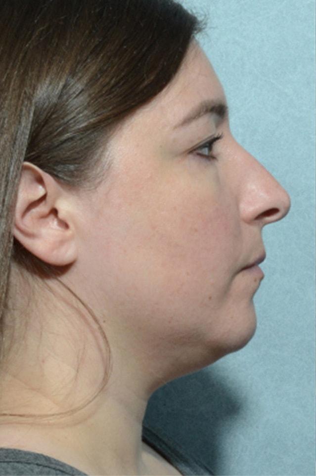 Rhinoplasty before at Chegar Facial Plastic Surgery in Carmel, IN