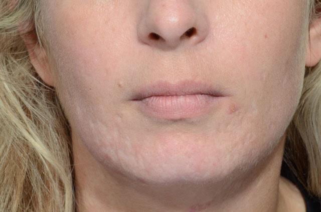 Laser Skin Resurfacing before at Chegar Facial Plastic Surgery in Carmel, IN