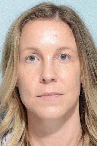 Chegar Facial Plastic Surgery brow lift after — Carmel, IN
