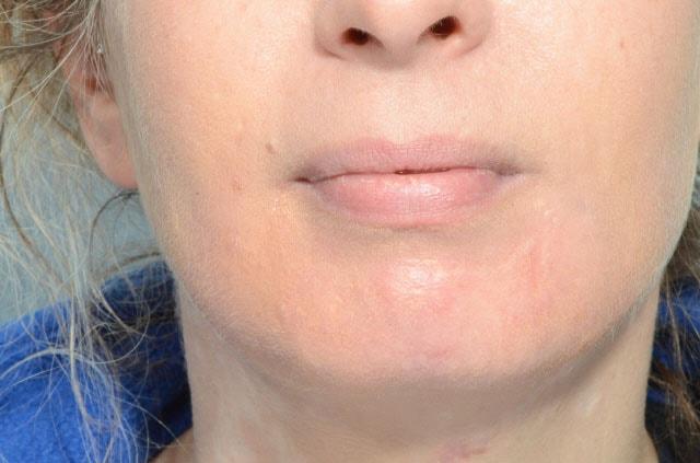 Laser Skin Resurfacing after at Chegar Facial Plastic Surgery in Carmel, IN