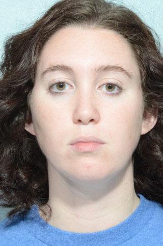Rhinoplasty after at Chegar Facial Plastic Surgery in Carmel, IN