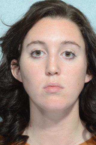 Rhinoplasty before at Chegar Facial Plastic Surgery in Carmel, IN