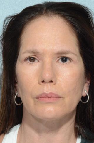 Chegar Facial Plastic Surgery rhinoplasty after — Carmel, IN